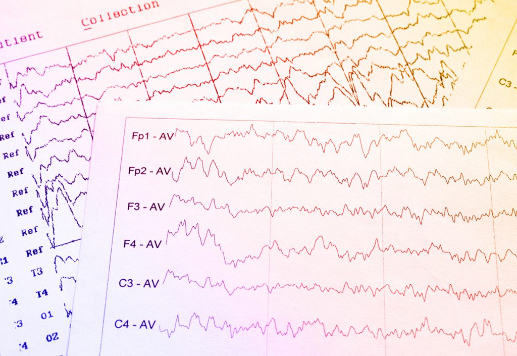 EEG monitoring of electrical activity of the brain