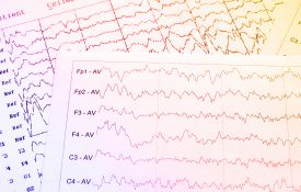 EEG monitoring of electrical activity of the brain