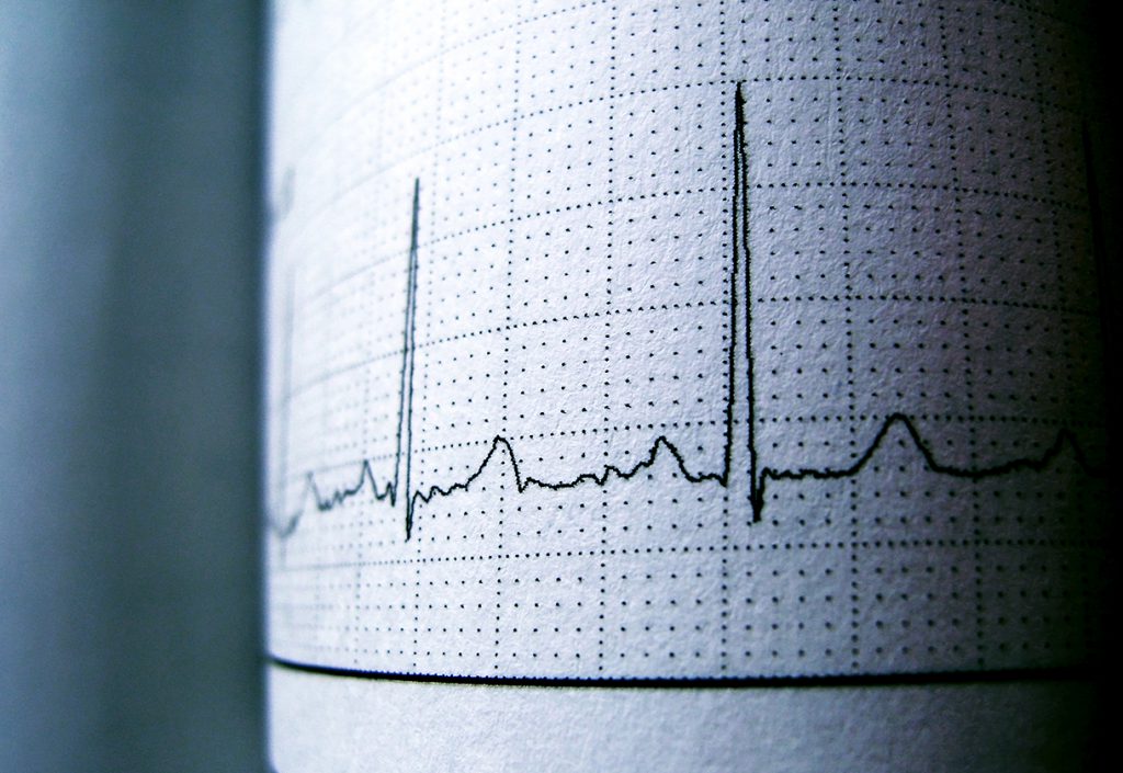 Sinus Heart Rhythm On Electrocardiogram